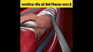 थायरॉयड ग्लैंड को कैसे निकाला जाता है🤔–How is the thyroid gland removed from the throat? #shorts