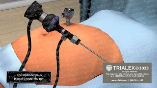 Insertion of Laparoscopic Trocar Animation