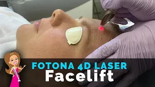 What Does Fotona 4D Laser Feels Like? | Laser FACELIFT | Laser Skin Tightening | Build Collagen