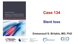 Case 134: Manual of PCI - Stent loss