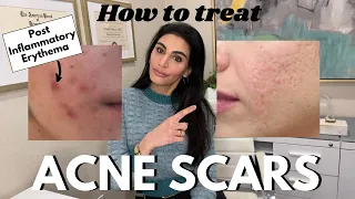 How to treat Acne Scars (Post Inflammatory Erythema, Hyperpigmentation, and etc)! | SkinByDrAzi