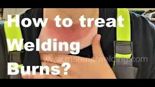 How to treat welding burns