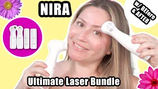 NIRA LASER Ultimate Laser Bundle | w before & afters #niralaser