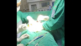 C section delivery | To New Born baby washing