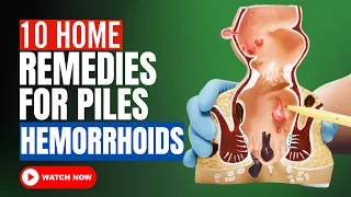10 Home Remedies For HEMORRHOIDS [Internal and External] | Hemorrhoid Treatment | Piles Treatment