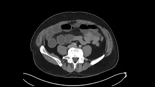 Mesenteric desmoid