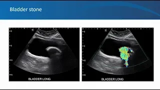 Renal ultrasound video 5, Twinkle artefact, University of Florida Nephrology, by Dr. Koratala