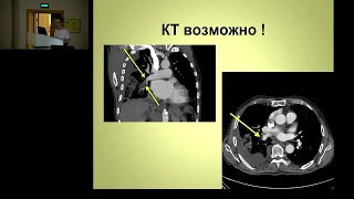 Тромбоэмболия легочной артерии ТЭЛА  Kошкина Е.В.