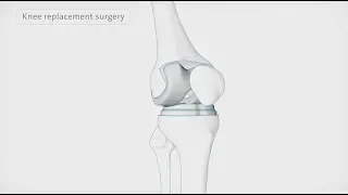 How is a knee replacement performed | Spire Healthcare