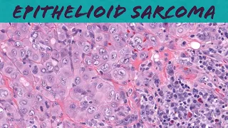 Epithelioid sarcoma (explained in 5 minutes) ‪- pathology dermpath dermatology dermatopathology