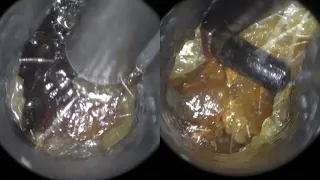 35 - Complex Ear Wax Removal with the WAXscope®️