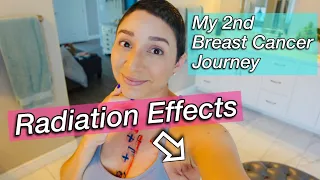 Radiation Effects; See the effects of radiation therapy on my skin & How I'm feeling