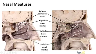 Nasal Cavity, Sinuses and Ear LO - Nasal Walls