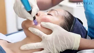 Micro-needling Full Training Video