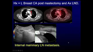 PET CT for breast cancer