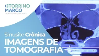 Veja Como é Uma Tomografia de Quem Tem SINUSITE Maxilar Crônica - Otorrino Marco