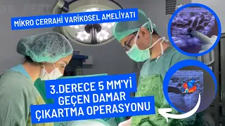 Damar Çıkartma Mikro Cerrahi #Varikosel Ameliyatı