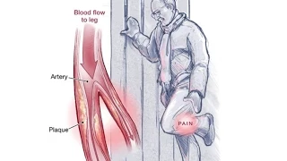 Peripheral Arterial Disease