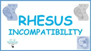 Rhesus Incompatibility: pathophysiology, genetic basis, effects on mother and fetus, management