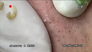 Acne video removal, Blackhead clearing video