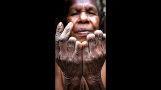 Finger Amputation In Dani Tribe - Strange Way Of Mourning The Beloved Ones #shorts