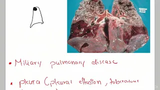 Tuberculosis +Case