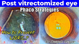 Phacoemulsification in a Post Vitrectomized  eye. Strategies to follow - Dr Deepak Megur