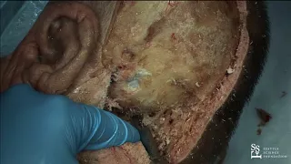 Far Lateral Craniotomy for PICA and Vertebral Basilar Junction - Aaron Dumont, M.D., FACS, FAHA