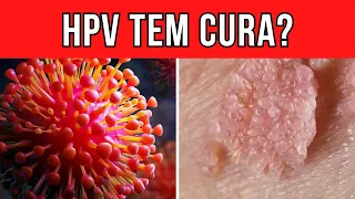 Existe Cura ou Tratamento Para o Vírus HPV?