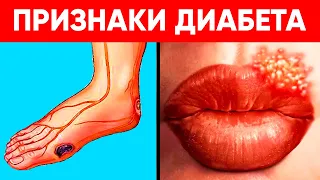 10 Ранних Признаков Что у Вас ДИАБЕТ. Большинство Игнорируют ЭТО! (Профилактика диабета)