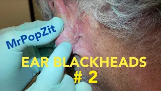 Ear Blackheads part 2, 6 week follow up. Plenty of keratin hiding in the crevices. Extractions.