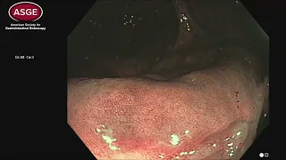 Diagnosing Clip Artifact