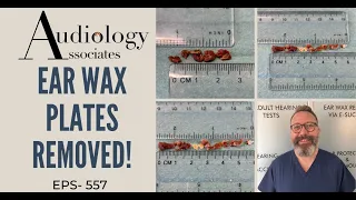 EAR WAX PLATES REMOVED - EP557