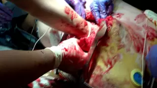 Open Thoracotomy (Viewer Discretion Advised)