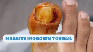 HE HAS THIS MASSIVE INGROWN TOENAIL FOR A LONG TIME