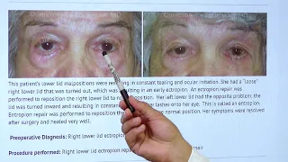 Eyelid Malpositions Beverly Hills