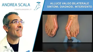 Alluce valgo bilaterale: sintomi, diagnosi e intervento | Dott. Andrea Scala specialista del piede