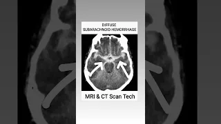 Subarachnoid Hemorrhage CT Scan #viral #youtubeshorts #ct #shortsfeed