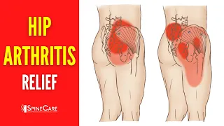 How to Relieve Hip Arthritis Pain in 30 SECONDS