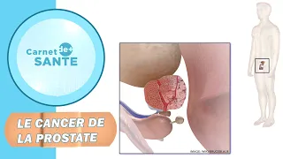 Carnet de Santé | Le cancer de la prostate