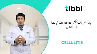 Cellulitis: Symptoms, Causes, Treatment & Recovery | tibbi