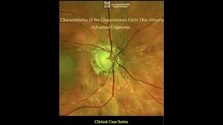 Advanced Glaucoma. Optic Disc Changes. #glaucoma #eyedisease