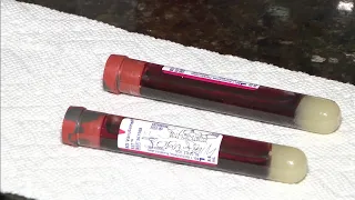 Blood test can check your COVID-19 immunity after vaccine