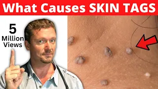 What SKIN TAGS Really Mean  (What Causes Skin Tags?)