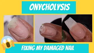 Onycholysis |Uuggghh I damaged my nail | Fixing my separated, damaged nail