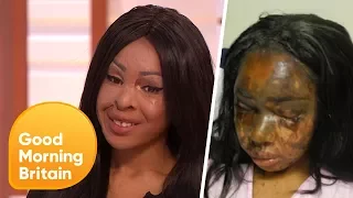 Recovering From an Acid Attack - 5 Years on | Good Morning Britain