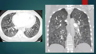 3/6/21- Diffuse Cystic Lung Disease -- Dr. Gwizdala