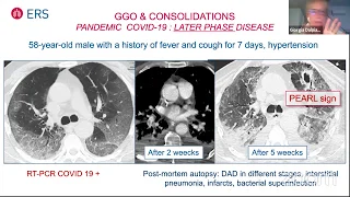 COVID-19 and the management of Interstitial Lung Diseases patients: challenges and recommendations