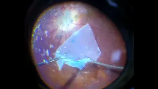 Retinal detachment secondary to Morning glory syndrome: Vitrectomy with amnion membrane