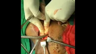 Open Reduction of Major Facial Fracture
